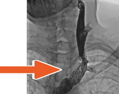 Xray showing blockage in artery in neck.