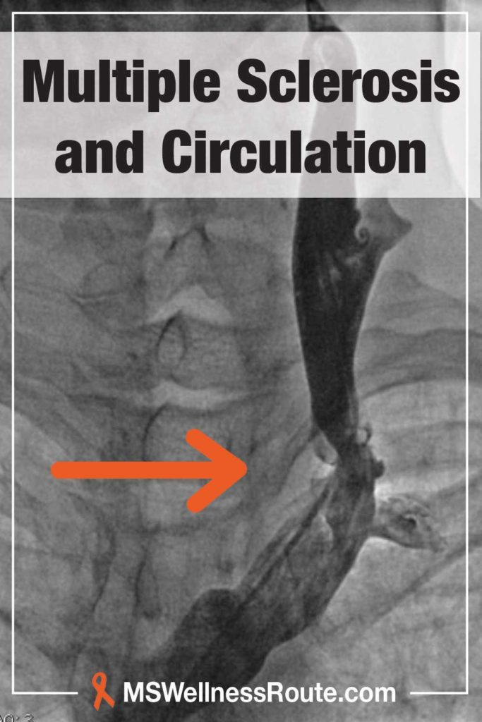 Angioplasty being performed on carotid artery in neck with headline: Multiple Sclerosis and Circulation