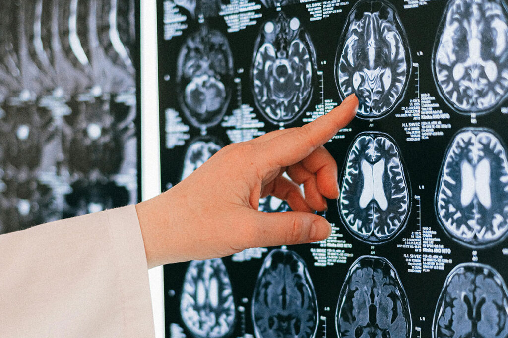 Close up of someones hand pointing at image of an MRI scan of the brain.